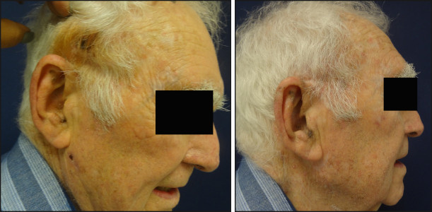 facelift